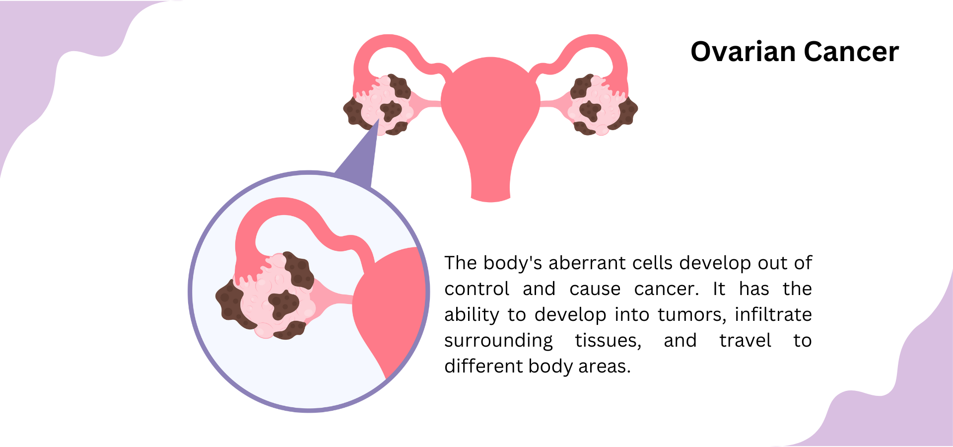 Ovarian cancer